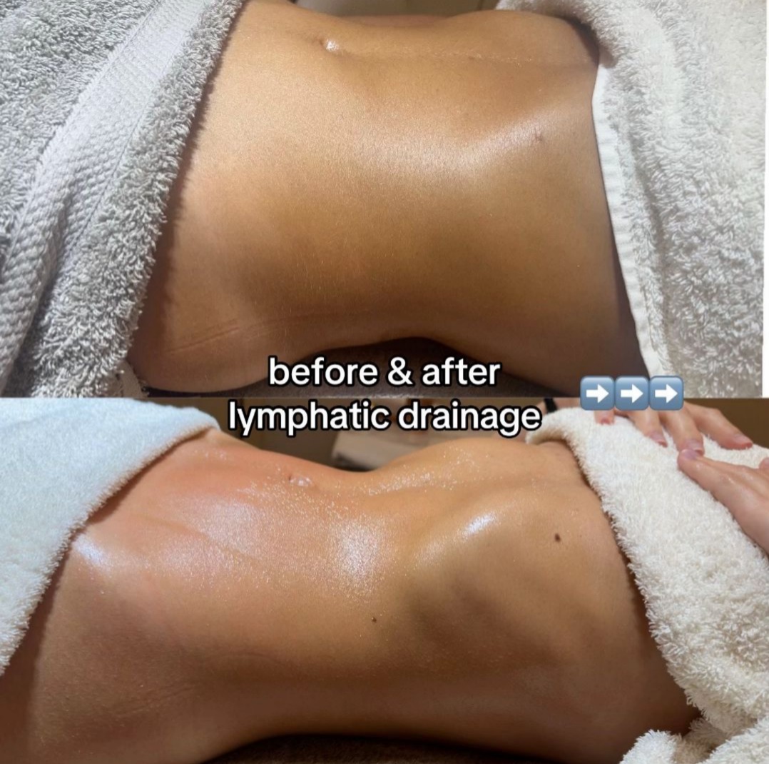 Before and after lymphatic drainage — Abdominal Lymphatic Drainage