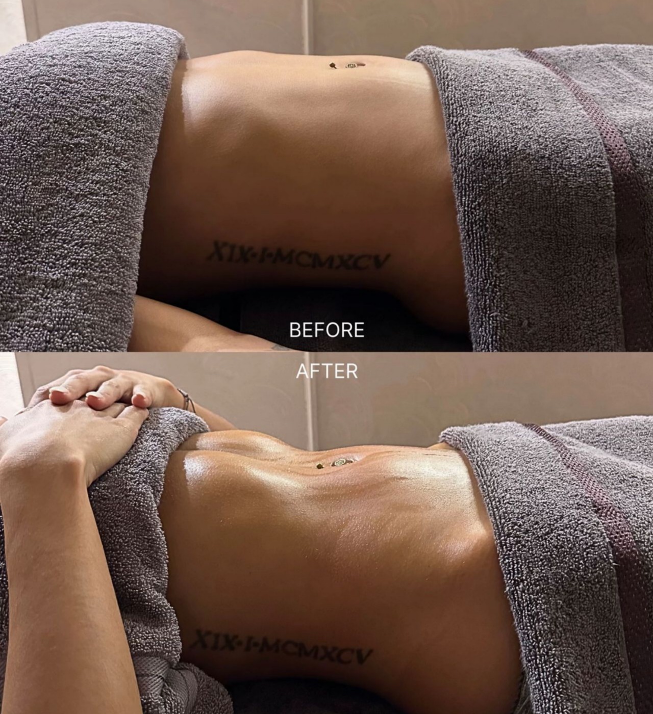 Before and after lymphatic drainage — Tummy Tuck Recovery Progress