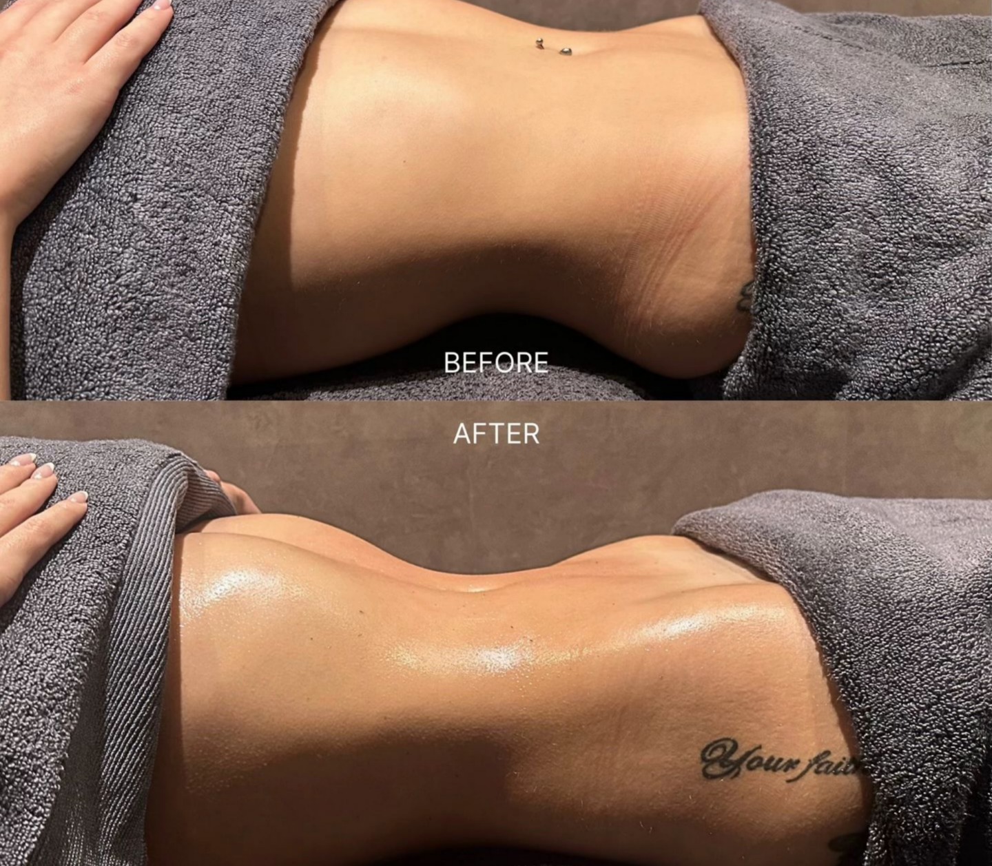 Before and after lymphatic drainage — Liposuction Recovery Progress
