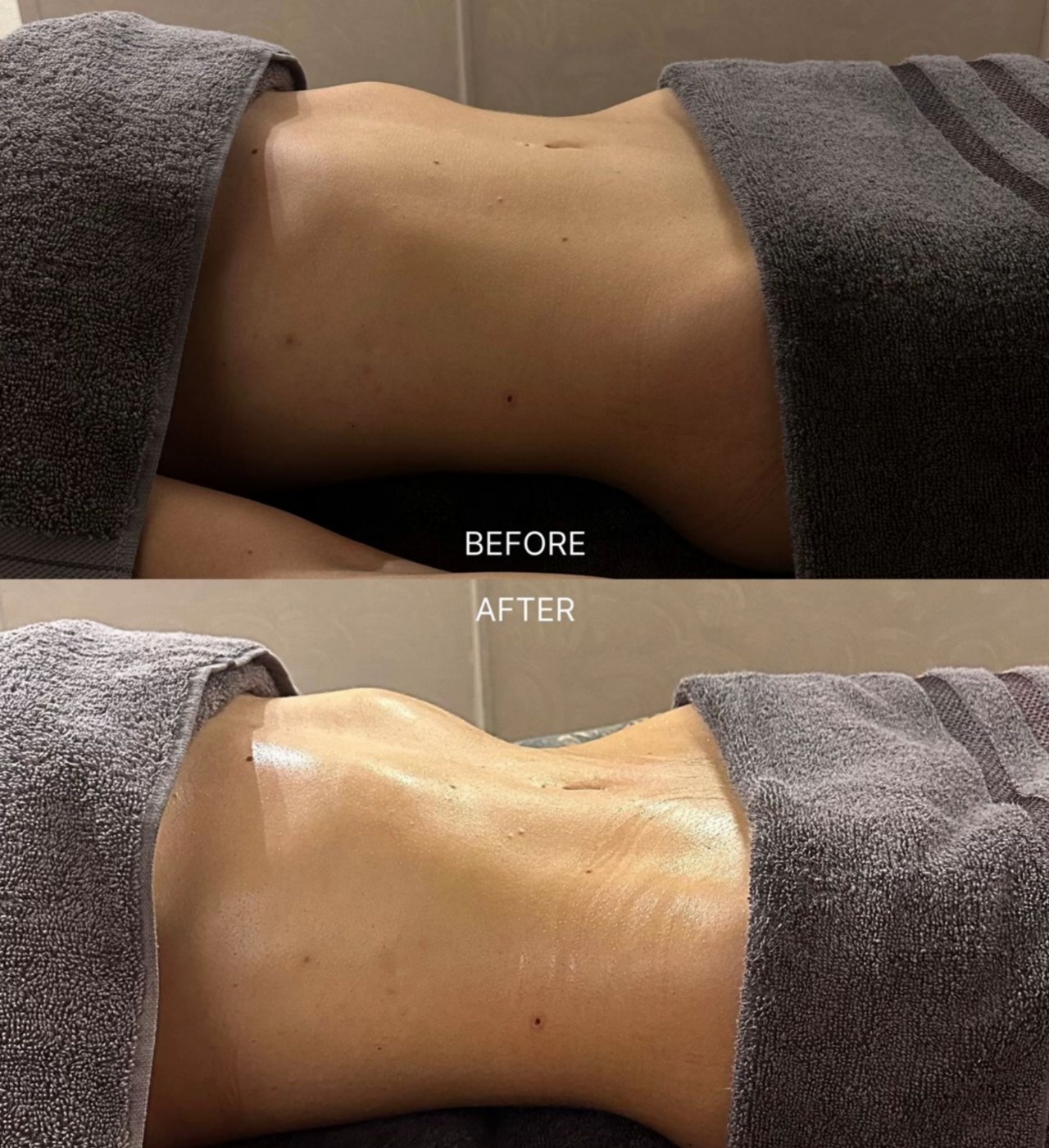 Liposuction Recovery — before and after lymphatic drainage